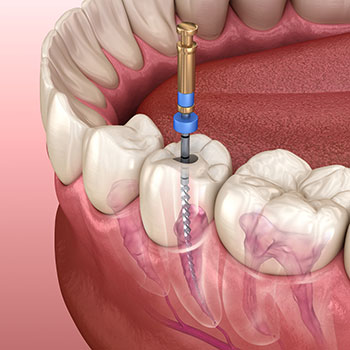 root canal treatment