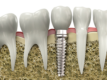 350x dental implants3