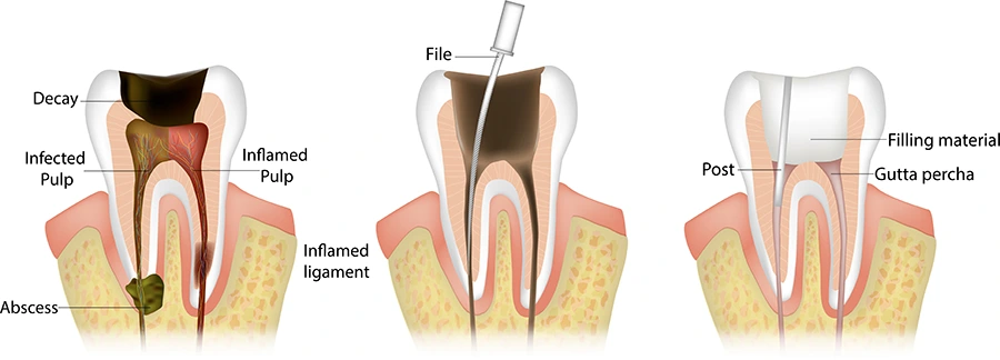 how does root canal treatment work