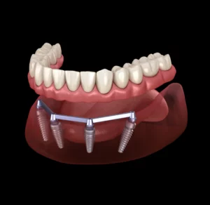 All-on-4 dental implants procedure