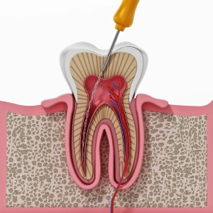 The Procedure of Root Canal