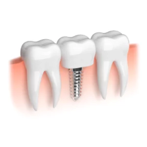 What to Expect During Dental Implant Procedures
