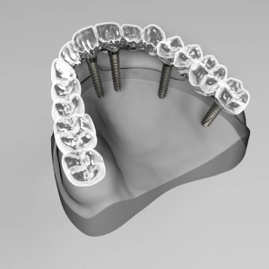 Do Dental Implants Hurt After Surgery