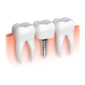 Traditional Dental Implants