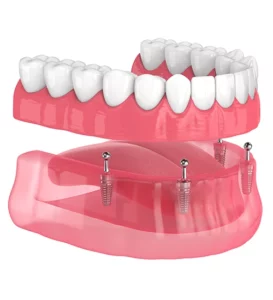 All-on-4 Dental Implants Cost