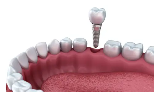 Dental Implants
